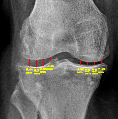 Calculating Joint Space Narrowing (JSN)